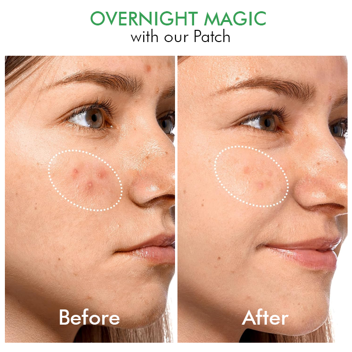 Oveallgo™ Overnight Hydrocolloid Acne Clear Patches